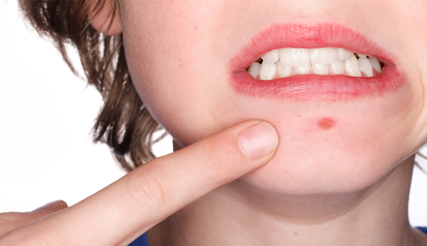A woman pointing at a pimple